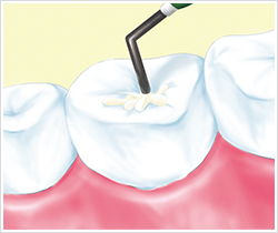 イラスト：口腔内のチェック、歯石除去、むし歯、出血検査