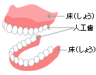 レジン床義歯