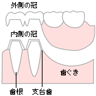 コーヌスクローネ義歯
