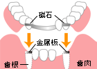 アタッチメント義歯