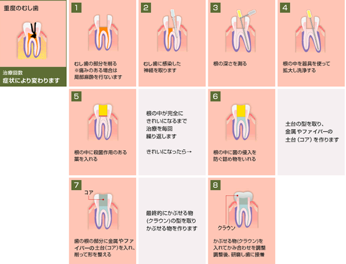 重度のむし歯の処置例
