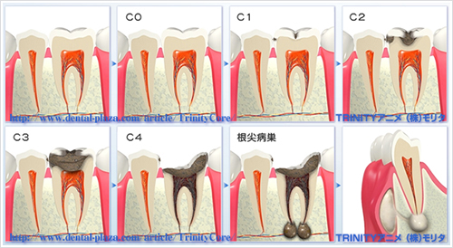 イラスト：むし歯の進行