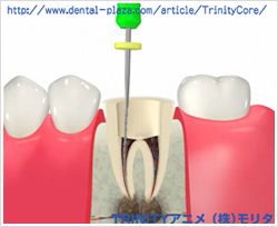 イラスト：根の治療（根管治療）