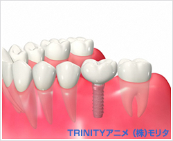 イラスト：インプラント