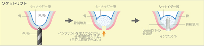 イラスト：ソケットリフト