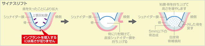 イラスト：サイナスリフト