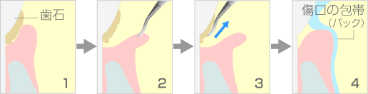 歯肉剥離掻爬術