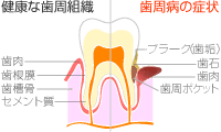 歯周病の様子