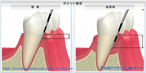 歯周ポケット