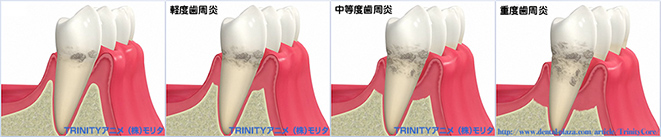歯周病の進行