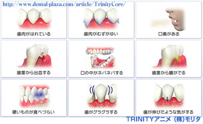 重度歯周病の場合の症状