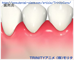 イラスト：口腔内のチェック、歯石除去、むし歯、出血検査
