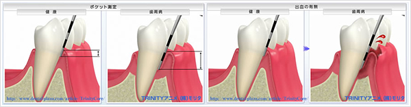 イラスト：歯周病のチェック及び歯周ポケットの深さ測定
